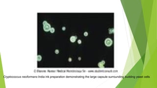 Cryptococcus neoformans India ink preparation demonstrating the large capsule surrounding budding yeast cells
 