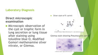 Laboratory Diagnosis
Direct microscopic
examination
 Microscopic observation of
the cyst or trophic form in
lung secretion or lung tissue
after staining using
toluidine blue O, Modified
Gomori methenamine silver
nitrate, or Giemsa.
 Silver stain of P. carinii
Giemsa stain showing Pneumocystis carinii
 