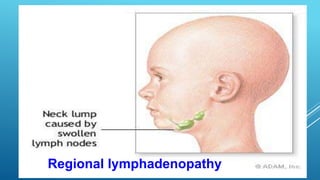 Regional lymphadenopathy
 