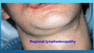 Regional lymphadenopathy
 