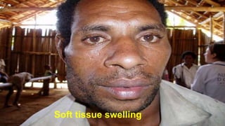 Soft tissue swelling
 