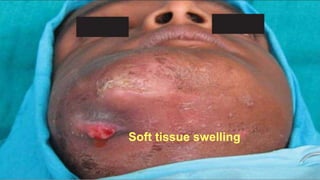 Soft tissue swelling
 