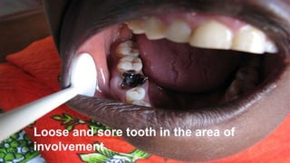 Loose and sore tooth in the area of
involvement
 