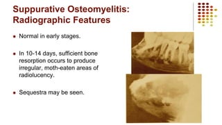 Suppurative Osteomyelitis:
Radiographic Features
 Normal in early stages.
 In 10-14 days, sufficient bone
resorption occurs to produce
irregular, moth-eaten areas of
radiolucency.
 Sequestra may be seen.
 