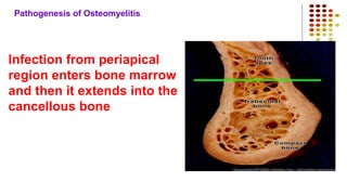 Pathogenesis of Osteomyelitis
Infection from periapical
region enters bone marrow
and then it extends into the
cancellous bone
 