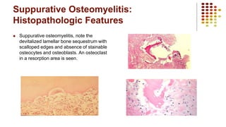 Suppurative Osteomyelitis:
Histopathologic Features
 Suppurative osteomyelitis, note the
devitalized lamellar bone sequestrum with
scalloped edges and absence of stainable
osteocytes and osteoblasts. An osteoclast
in a resorption area is seen.
 