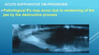 ACUTE SUPPURATIVE OM-PROGNOSIS
Pathological #’s may occur due to weakening of the
jaw by the destructive process
 