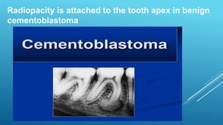 Radiopacity is attached to the tooth apex in benign
cementoblastoma
 