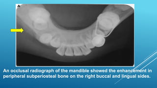 An occlusal radiograph of the mandible showed the enhancement in
peripheral subperiosteal bone on the right buccal and lingual sides.
 