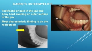 GARRE’S OSTEOMYELITIS
Toothache or pain in the jaw and
bony hard swelling on outer surface
of the jaw
Most characteristic finding is on the
radiograph
 