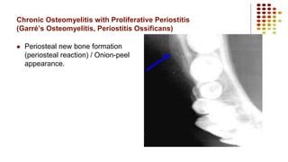 Chronic Osteomyelitis with Proliferative Periostitis
(Garré’s Osteomyelitis, Periostitis Ossificans)
 Periosteal new bone formation
(periosteal reaction) / Onion-peel
appearance.
 