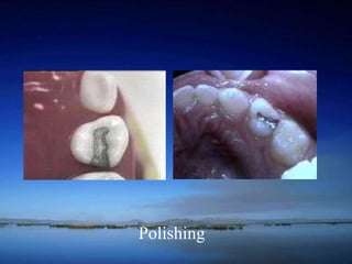 Polishing 
 