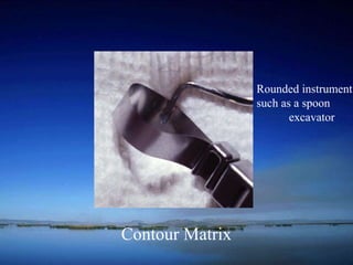 Contour Matrix 
Rounded instrument 
such as a spoon 
excavator 
 