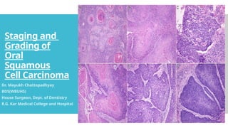 Staging and Grading of Oral Squamous Cell Carcinoma | PPTX