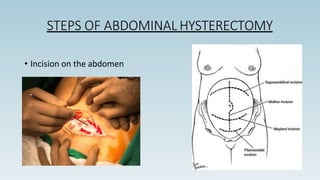 STEPS OF ABDOMINAL HYSTERECTOMY
• Incision on the abdomen
 