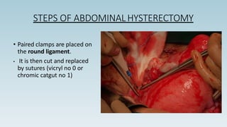 • Paired clamps are placed on
the round ligament.
• It is then cut and replaced
by sutures (vicryl no 0 or
chromic catgut no 1)
STEPS OF ABDOMINAL HYSTERECTOMY
 