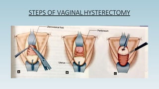 STEPS OF VAGINAL HYSTERECTOMY
 