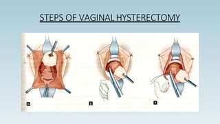STEPS OF VAGINAL HYSTERECTOMY
 