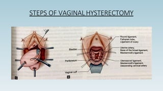 STEPS OF VAGINAL HYSTERECTOMY
 