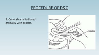 PROCEDURE OF D&C
5. Cervical canal is dilated
gradually with dilators.
 