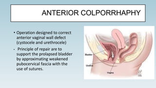 • Operation designed to correct
anterior vaginal wall defect
(cystocele and urethrocele)
• Principle of repair are to
support the prolapsed bladder
by approximating weakened
pubocervical fascia with the
use of sutures.
ANTERIOR COLPORRHAPHY
 