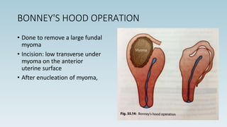 BONNEY'S HOOD OPERATION
• Done to remove a large fundal
myoma
• Incision: low transverse under
myoma on the anterior
uterine surface
• After enucleation of myoma,
 