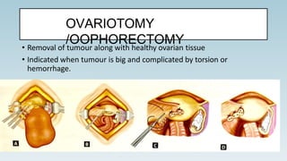 OVARIOTOMY
/OOPHORECTOMY• Removal of tumour along with healthy ovarian tissue
• Indicated when tumour is big and complicated by torsion or
hemorrhage.
 