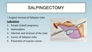 SALPINGECTOMY
• Surgical removal of fallopian tube
Indications
1. Ectopic (tubal) pregnancy
2. Hydrosalpinx
3. Infection and stricture of the tube
4. Cancer of fallopian tube
5. Prevention of ovarian cancer
 