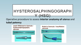 HYSTEROSALPHINGOGRAPH
Y (HSG)
Operative procedure to assess interior anatomy of uterus and
tubal patency
 