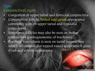 Trachoma | PPTX