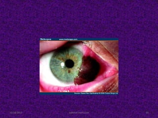 11/18/2013 ophthal short case 10
 