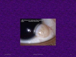 11/18/2013 ophthal short case 11
 