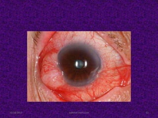 11/18/2013 ophthal short case 12
 