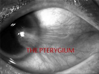 THE PTERYGIUM
 