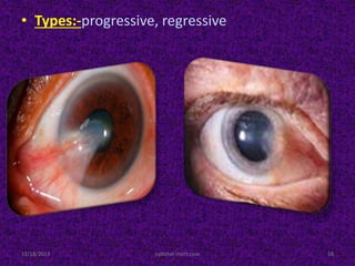 • Types:-progressive, regressive
11/18/2013 ophthal short case 18
 