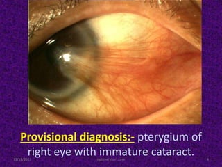 Provisional diagnosis:- pterygium of
right eye with immature cataract.11/18/2013 4ophthal short case
 
