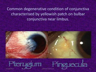 Common degenerative condition of conjunctiva
characterised by yellowish patch on bulbar
conjunctiva near limbus.
11/18/2013 8ophthal short case
 