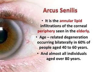 • It is the annular lipid
infiltrations of the corneal
periphery seen in the elderly.
• Age – related degeneration
occurring bilaterally in 60% of
people aged 40 to 60 years.
• And almost all individuals
aged over 80 years.
10
 