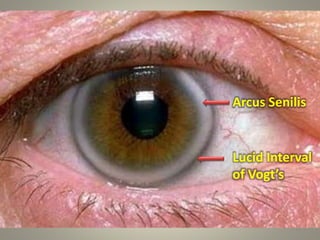 Arcus Senilis
Lucid Interval
of Vogt’s
12
 