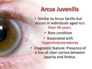 • Similar to Arcus Senilis but
occurs in individuals aged less
than 40 years.
• Rare condition
• Associated with
Hypercholesterolemia
• Diagnostic feature: Presence of
a line of clear cornea between
opacity and limbus.
14
 