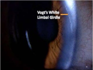 16
Vogt’s White
Limbal Girdle
 