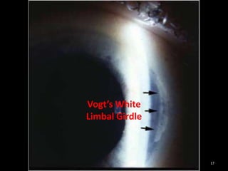 17
Vogt’s White
Limbal Girdle
 