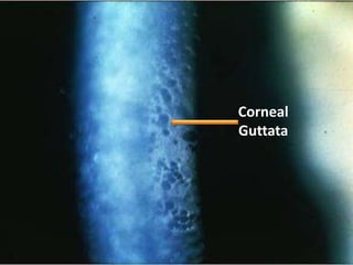 19
Corneal
Guttata
 