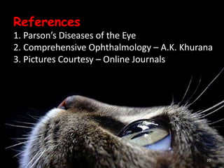 References
1. Parson’s Diseases of the Eye
2. Comprehensive Ophthalmology – A.K. Khurana
3. Pictures Courtesy – Online Journals
20
 