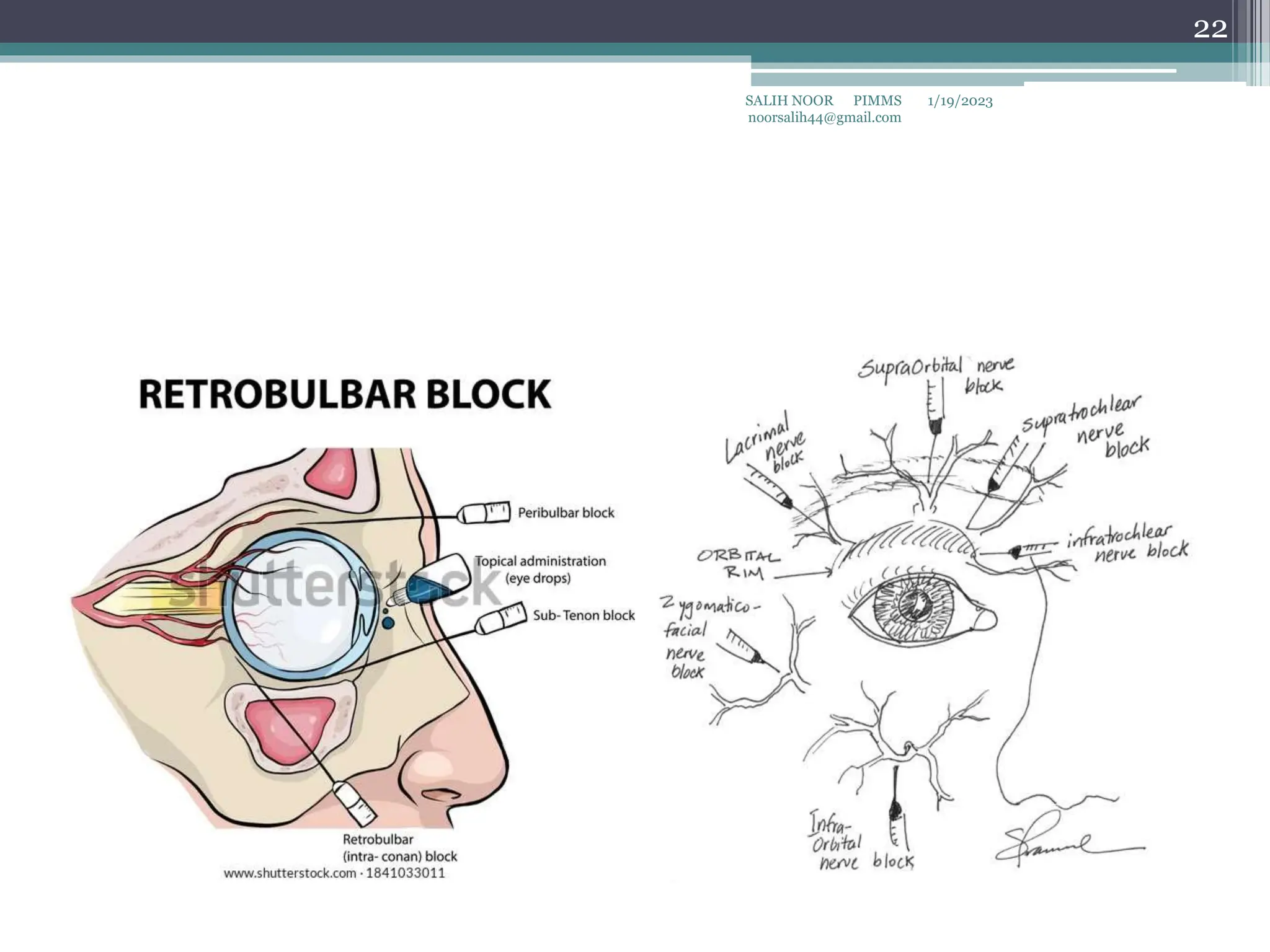 Opthalmic_Surgery.pptx_3_by_SALIH_NOOR.pptx