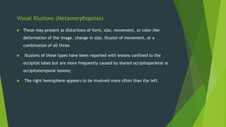 Visual Illusions (Metamorphopsias)
 These may present as distortions of form, size, movement, or color like
deformation of the image, change in size, illusion of movement, or a
combination of all three.
 Illusions of these types have been reported with lesions confined to the
occipital lobes but are more frequently caused by shared occipitoparietal or
occipitotemporal lesions;
 The right hemisphere appears to be involved more often than the left.
 