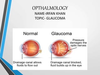 OPTHALMOLOGY
NAME-IRFAN KHAN
TOPIC- GLAUCOMA
 
