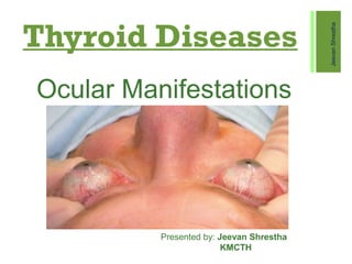 Thyroid Diseases
Ocular Manifestations
JeevanShrestha
Presented by: Jeevan Shrestha
KMCTH
 