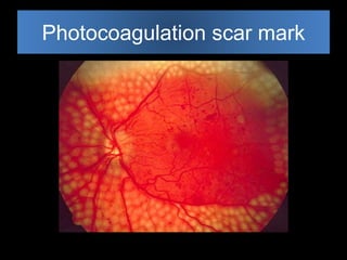 Photocoagulation scar mark 
 