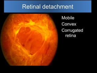 Retinal detachment 
Mobile 
Convex 
Corrugated 
retina 
 